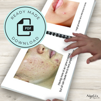 Thumbnail for Social Narrative: Acne: Editable (Printable PDF ) Puberty - AdaptEd4SpecialEd